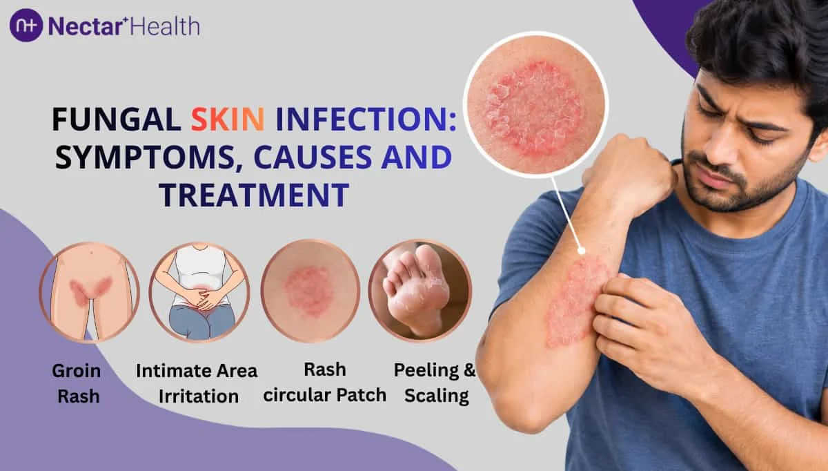 Fungal Skin Infection: Symptoms, Causes, Treatment and Prevention